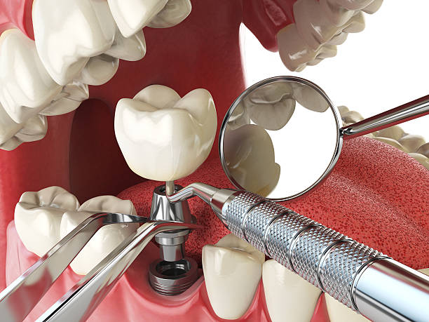 Best Broken or Cracked Tooth Emergency Dentist in Lake Morton Berrydale, WA